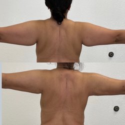 Bella Forme Medical - Liposuction of arms