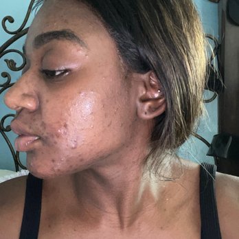 SOS Skincare - Before going to Connie - Skin Care Near Me - Los Angeles, California