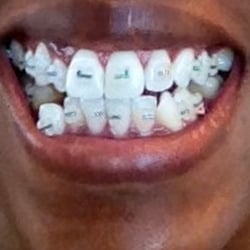 Stieg & Wachtel Orthodontics - My before... Woof!