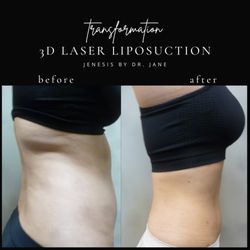 Jenesis Lipoplasty & Laser