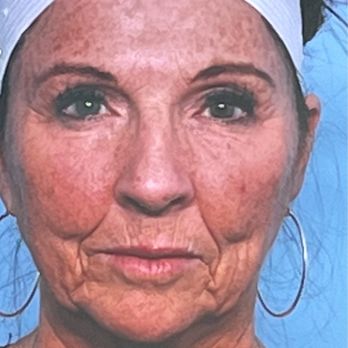 The Maercks Institute - This is pre op. Day before surgery. - Plastic Surgeons Near Me - Miami, Florida The Maercks Institute - This is pre op. Day before surgery. - Plastic Surgeons Near Me - Miami, Florida