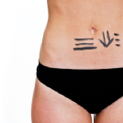 Longevity Institute of Indiana - Markings for cosmetic surgery