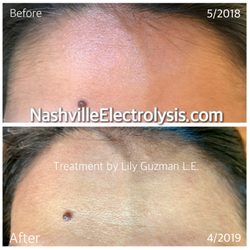 Nashville Electrolysis