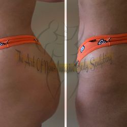 Keep it tight Body Contouring