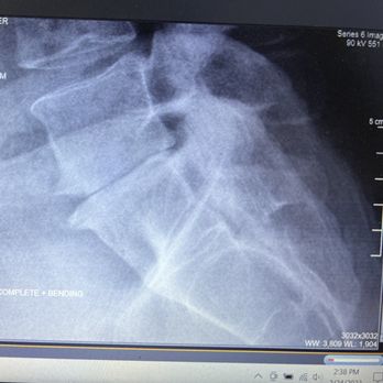 Brian Su, MD - My degenerated L5 disk - Orthopedists Near Me - Larkspur, California
