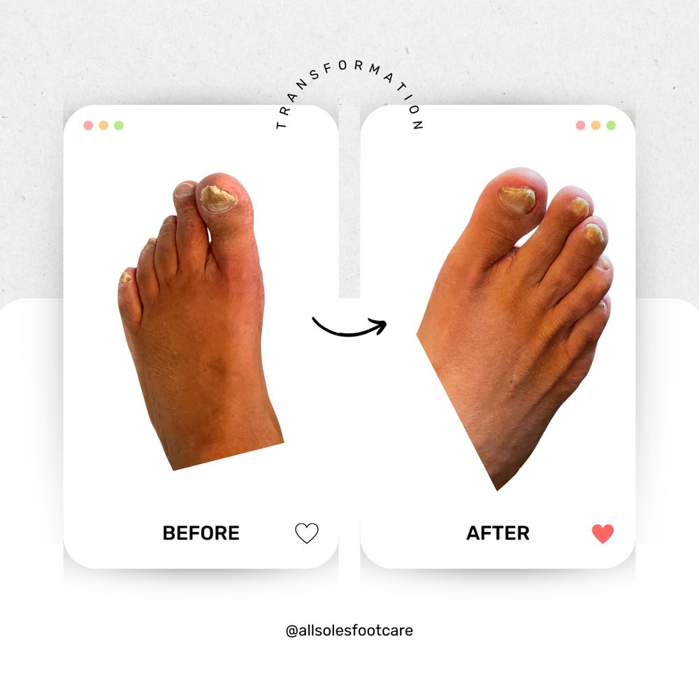 ALL SOLES FOOT CARE Updated April 2024 Edmonton, Alberta, Canada