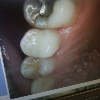 Memorial City Smiles - This use to have a crater now it's like a brand new tooth. Go Dr.Moravej and thank you - Cosmetic Dentists Near Me - Houston, Texas