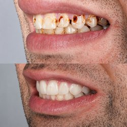 Clínica de Ortodoncia & Estética Dental - Smile design with metal-free porcelain crowns, restoring function, aesthetics, and creating a natural, harmonious smile.