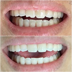 Serene Smiles Dental - Fixed a chipped tooth for a patient who got into an accident