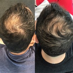 Eterna Medical Spa - PRP Hair Growth Treatment