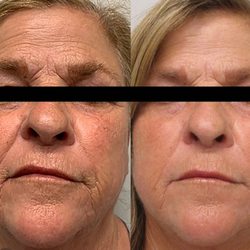 Fixation Med Spa - Morpheus8 Skin tightening