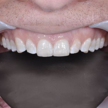 Grace Jun - Pragma Dental - Pragma Dental Smile Results - After Transformation - Cosmetic Dentists Near Me - Oklahoma City, Oklahoma Grace Jun - Pragma Dental - Pragma Dental Smile Results - After Transformation - Cosmetic Dentists Near Me - Oklahoma City, Oklahoma