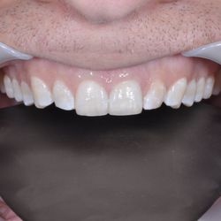 Grace Jun -  Pragma Dental - Pragma Dental Smile Results - After Transformation