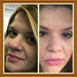Cosmetic Medicine of Coral Gables - Before and after Botox on forehead. Thank you Cosmetic Medicine of Coral Gables!