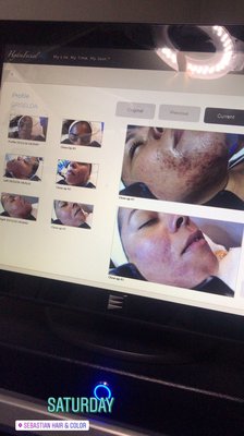 STEMZYME™ 5 Treatments 🧖♀️ - This isn't a facial. This is a complete skin revision.
STEMZYME™ is our most advanced, results-driven treatment program — a 50-day skin transformation plan that combines the power of stem cell technology and enzyme therapy into 5 precision treatments, spaced every 12 days for maximum cellular regeneration.
What's included:
✅ Full STEMZYME™ kit — all 5 treatments
✅ Full-size professional homecare regimen
✅ Expert guidance through your entire 50-day plan
✅ Visible, measurable results that compound with every session
This program targets:
Deep wrinkles & fine lines
Skin laxity & loss of firmness
Hyperpigmentation & uneven tone
Acne scarring & texture damage
Dull, depleted, aging skin
Clients who complete the full 5-treatment series consistently report their skin looks years younger — with results that continue improving even after the program ends.
⚠️ Spots are extremely limited. Treatments cannot be put on hold once your plan begins. Must confirm scheduling before purchasing.
📍 It's Your Beauty Time | 7857 Florence Ave, Suite 202, Downey, CA 90240
📞 562-334-2886 | 💻 itsyourbeautytime.com STEMZYME™ 5 Treatments 🧖♀️ - This isn't a facial. This is a complete skin revision.
STEMZYME™ is our most advanced, results-driven treatment program — a 50-day skin transformation plan that combines the power of stem cell technology and enzyme therapy into 5 precision treatments, spaced every 12 days for maximum cellular regeneration.
What's included:
✅ Full STEMZYME™ kit — all 5 treatments
✅ Full-size professional homecare regimen
✅ Expert guidance through your entire 50-day plan
✅ Visible, measurable results that compound with every session
This program targets:
Deep wrinkles & fine lines
Skin laxity & loss of firmness
Hyperpigmentation & uneven tone
Acne scarring & texture damage
Dull, depleted, aging skin
Clients who complete the full 5-treatment series consistently report their skin looks years younger — with results that continue improving even after the program ends.
⚠️ Spots are extremely limited. Treatments cannot be put on hold once your plan begins. Must confirm scheduling before purchasing.
📍 It's Your Beauty Time | 7857 Florence Ave, Suite 202, Downey, CA 90240
📞 562-334-2886 | 💻 itsyourbeautytime.com
