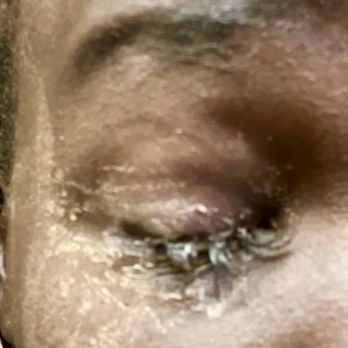 Tammy's Eyebrow Spa - Eyes glued shut with lashes still applied - Eyelash Service Near Me - New York, New York Tammy's Eyebrow Spa - Eyes glued shut with lashes still applied - Eyelash Service Near Me - New York, New York
