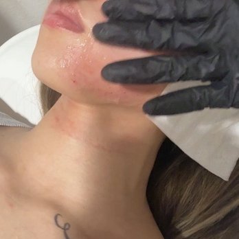 MeSO Medspa - Skin Pen Microneedling with PRP treatment - Skin Care Near Me - Anaheim, California MeSO Medspa - Skin Pen Microneedling with PRP treatment - Skin Care Near Me - Anaheim, California