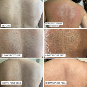 Dina Aesthetics - Acne Treatment Near Me - Dearborn Heights, Michigan Dina Aesthetics - Acne Treatment Near Me - Dearborn Heights, Michigan