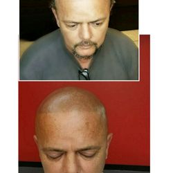 Artisan Scalp Micropigmentation