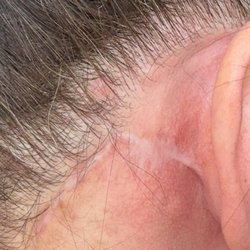 Milind K Ambe, MD - Too much tension on skin. Revision surgeons have said they know his work well and it is not a true deep plane facelift.