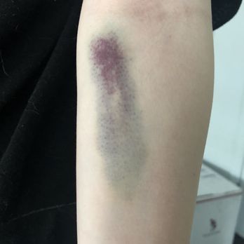 Quest Diagnostics - 2 days after vein was shredded at Quest Diagnostics. - Laboratory Testing Near Me - Bayside, New York