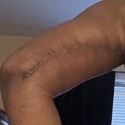 Ziyad Hammoudeh, MD - Left arm