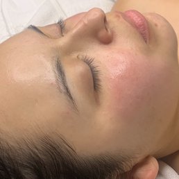 Post Facial Post Facial