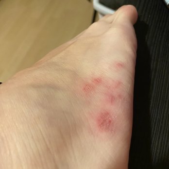 Nice Salon - The pedicurist scrubbed my feet area SO harshly that this happened. Paid a total of $90 including tip for this damage. - Hair Salons Near Me - Hayward, California