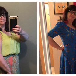Central California Surgery - Before and after pic of me