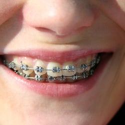 Laurent Orthodontics - Clear braces