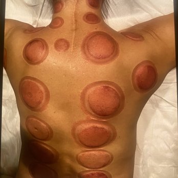 Angel Hands Wellness - Yes, the marks can look intimidating, but they dissipate overtime. - Massage Near Me - New York, New York