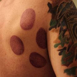Massage by ME - Cupping marks