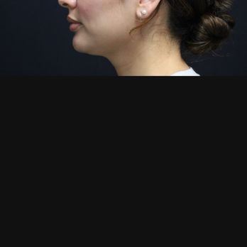 Folsom Plastic Surgery - Before - Laser Hair Removal Near Me - Folsom, California