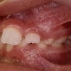 Trinity Orthodontics - Side view before