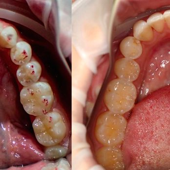 SF Dental - Before Vs After (Invisalign) - Cosmetic Dentists Near Me - San Francisco, California SF Dental - Before Vs After (Invisalign) - Cosmetic Dentists Near Me - San Francisco, California