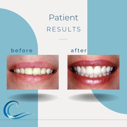 Christopher Catalano - Before & After Results with Christopher Catalano, DDS | Kentfield, CA
