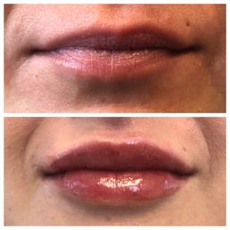 Restylane Defyne Restylane Defyne