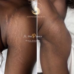 Stretchmark removal