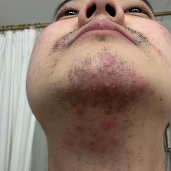 Eye Candy - Pimple outbreak 2 days after Laser Hair Removal Treatment. Chin area. Really bad and painful. - Eyelash Service Near Me - Buena Park, California