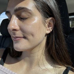Post microdermabrasion with Shelby