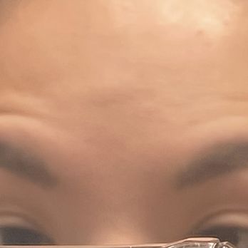 Younger World Med Spa - AFTER - my brown should not look like this!!! - Medical Spas Near Me - Downey, California Younger World Med Spa - AFTER - my brown should not look like this!!! - Medical Spas Near Me - Downey, California