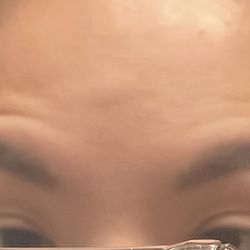 Younger World Med Spa - AFTER - my brown should not look like this!!!