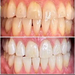 Deebeaut - Whitened teeth.
