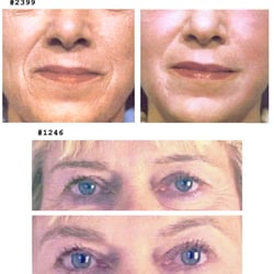 Microcurrent Face Sculpting