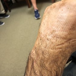 Lexington Orthopaedics West Columbia - Healing broken wrist