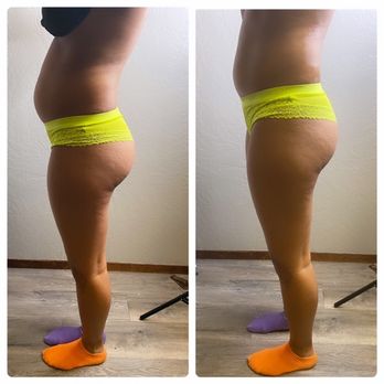 Levels To Skin - Body Contouring - Aestheticians Near Me - Citrus Heights, California Levels To Skin - Body Contouring - Aestheticians Near Me - Citrus Heights, California
