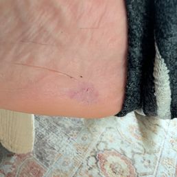 The damage the technician did while performing the callus removal procedure.