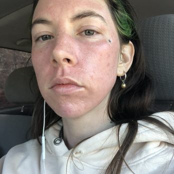 Artemedica - 2 days post treatment - Medical Spas Near Me - Santa Rosa, California Artemedica - 2 days post treatment - Medical Spas Near Me - Santa Rosa, California