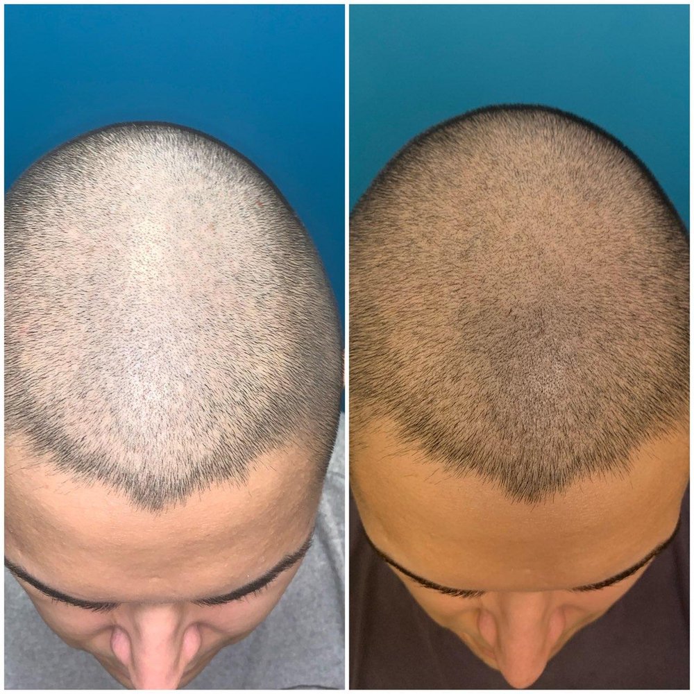 Vantis Institute - Before and After - Hair Loss Centers Near Me - Newport Beach, California Vantis Institute - Before and After - Hair Loss Centers Near Me - Newport Beach, California