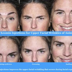 James Goodnight, MD - Everlasting Beauty - Xeomin injections